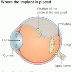 eye-implant